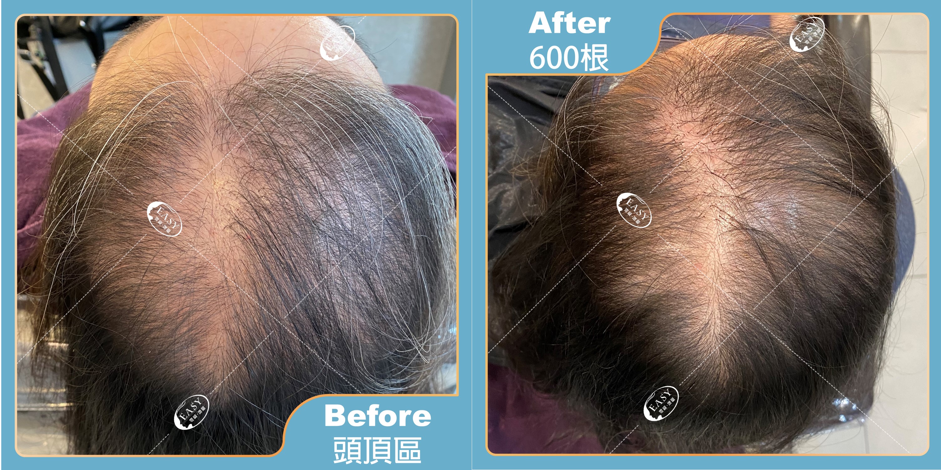 頂部髮量稀疏是因荷爾蒙減少，立即增量立即改善。